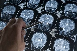 دانشمندان علت جدیدی برای بیماری آلزایمر کشف کردند_دانش دوست 2 دانشمندان علت جدیدی برای بیماری آلزایمر کشف کردند