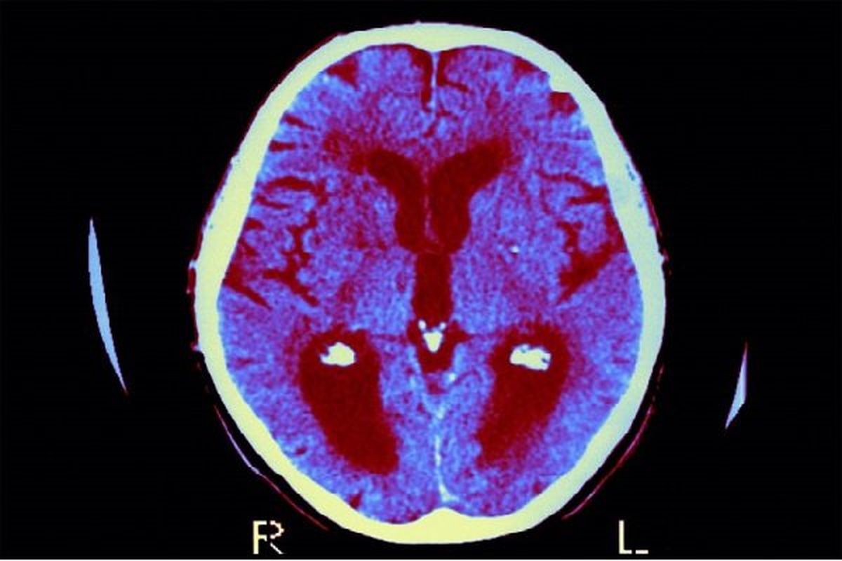 فراموشی زودهنگام در کودکان؛ یک دلیل خطرناک