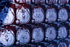 آلودگی هوا ‌می‌تواند ریسک خونریزی مغزی را افزایش دهد